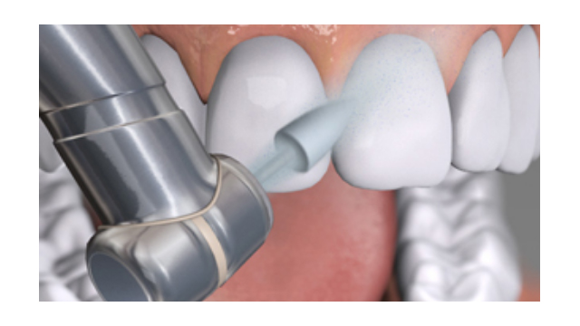 Restorativni materijali